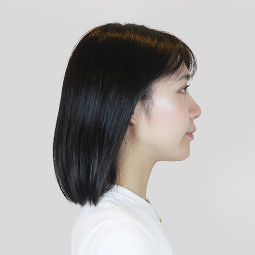 美容鍼灸施術を受けた後のあやな様20代