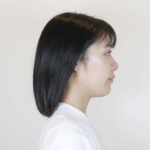 美容鍼灸施術を受ける前のあやな様20代